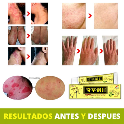 Crema Herbal China -  Natural para Psoriasis y Eccema
